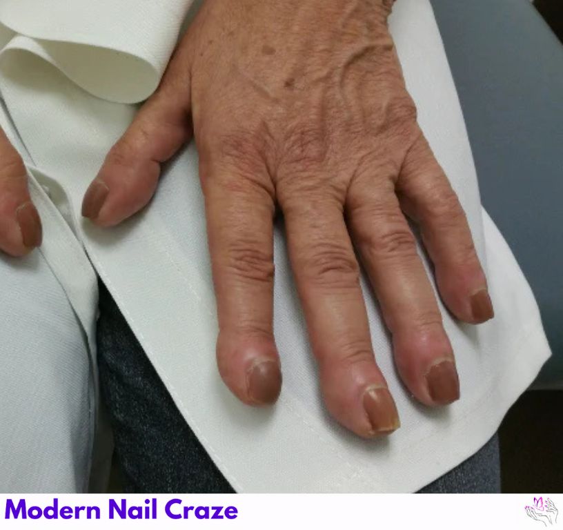 Curved Nails Vs. Clubbed Nails