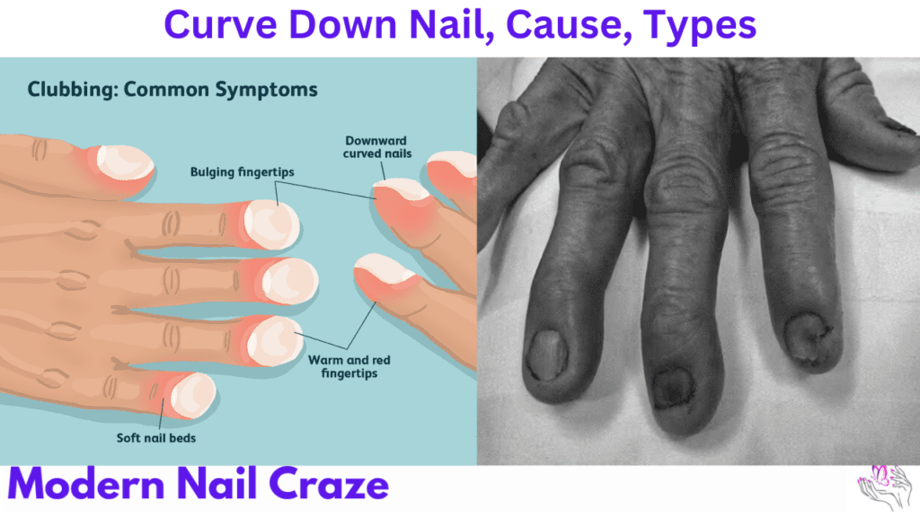 Curved Nails? A Hidden Danger No One Talks About