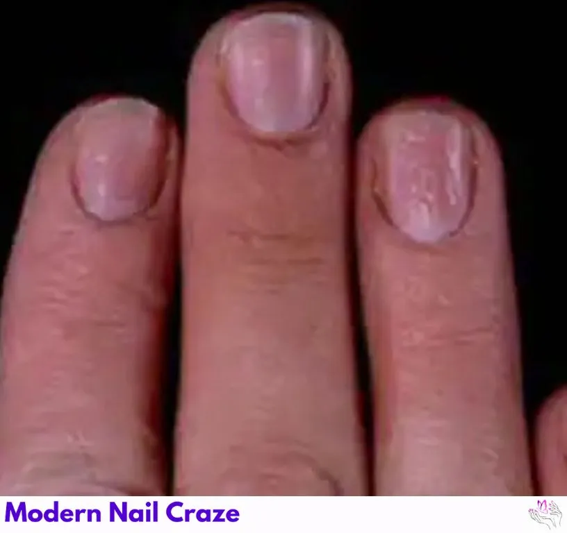 Nail with small depressions, linked to psoriasis or eczema.