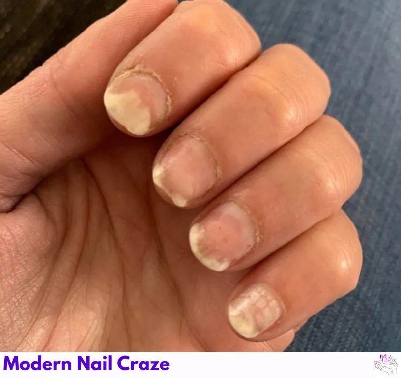 Lifted nail from bed, possibly due to thyroid issues.